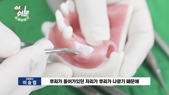 두둠 포트폴리오 - 서울BD치과병원 유튜브 영상 | 뼈이식 임플란트