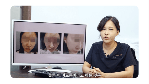 두둠 포트폴리오 - 주앤클리닉 시술 케이스리뷰 영상_여드름피부